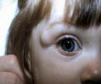 childrens dermoid cysts in the eye area