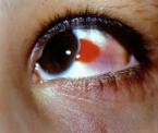 what is a subconjunctival hemorrhage