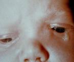 dacryocystocoele eye condition in newborns and in children