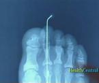 smart toe implant surgery for hammertoes