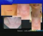 scarless thyroid surgery for women