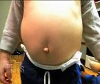 protruding belly button in children