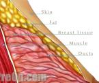 how to tell when a breast biopsy is needed