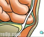 inguinal hernias and forms of hernias