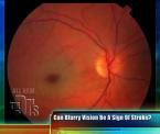 sudden blurred vision as a sign of a stroke