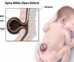 spina bifida meningocele and spina bifida occulta