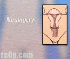 alternatives to hysterectomy uterus removal surgery