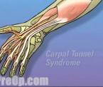 alternatives for carpal tunnel syndrome surgery