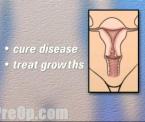 the effects of not having uterus and ovaries removal