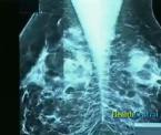 the i spy trial treatment for breast cancer