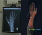 hand movement treatment for myelitis patients
