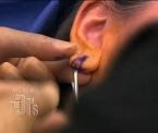 surgical fix for droopy earlobes