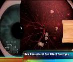 cholesterol deposits in the eye
