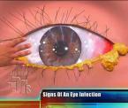 how to prevent conjunctivitis in children