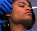softening the jaw line with botox