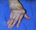 knuckle replacement surgery to relieve arthritic pain