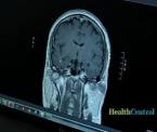 new surgery to stop epilepsy seizures