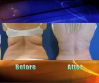 learn about lipocontrol