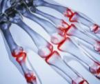 arthritis symptoms therapies and treatments