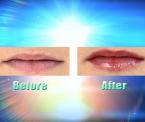 angel wing procedure for aging lips
