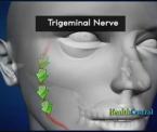 breakthrough surgery for trigeminal neuralgia