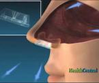 innovative device to treat sleep apnea