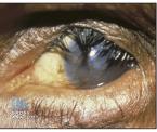 what is trachoma