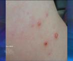 molluscum contagiosum sores in children