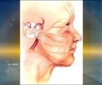 surgical solution for trigeminal neuralgia