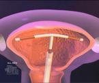 iuds may reduce cervical cancer risk