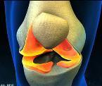 rheumatoid arthritis vs osteoarthritis