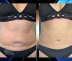 dawns water assisted liposuction results