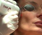 laser skin resurfacing