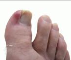 why you should stop biting your toenails