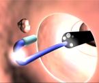 third eye retroscope device for colonoscopy