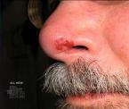 blisters on the nose as a sign for shingles