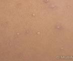 identifying molluscum contagiosum