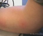 insect sting rash