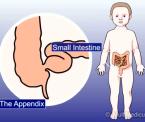 intussusception intestinal obstruction in children