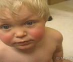 how to identify fifth disease rash