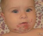 impetigo rash in children