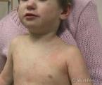 how to identify scarlet fever