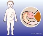 pediatric pyloric stenosis