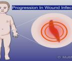 the development of infection on a wound