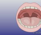 the causes symptoms and treatment for tonsillitis