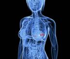 defining metastatic breast cancer