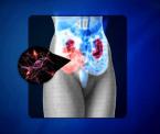 why women have more misdiagnosed hernias