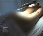 full bum rejuvenation
