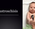 gastroschisis in newborns