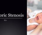 pyloric stenosis risk factors